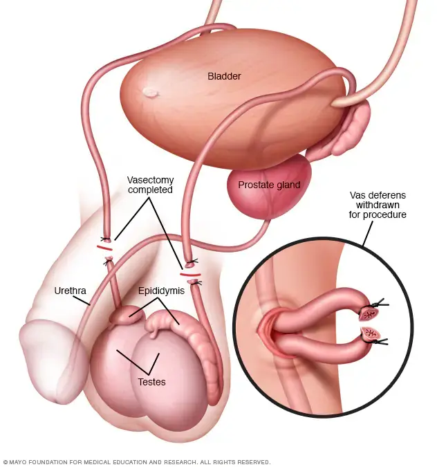 A Closer Look at the Vasectomy Procedure for Greenville Residents