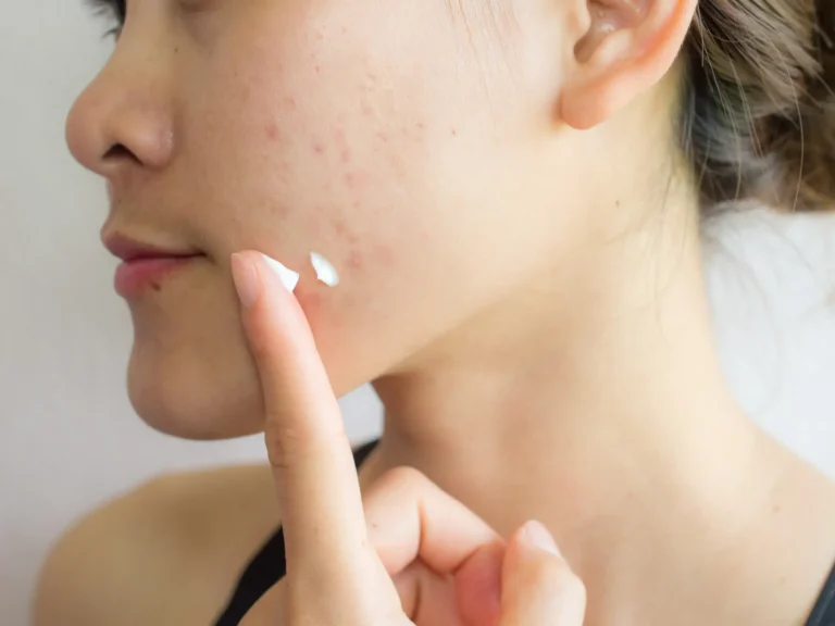 Why 14% Azelaic Acid Might Be the Sweet Spot for Sensitive, Acne-Prone Skin