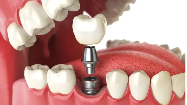 The Future of Tooth Replacement Advancements and Choices in Dental Implants